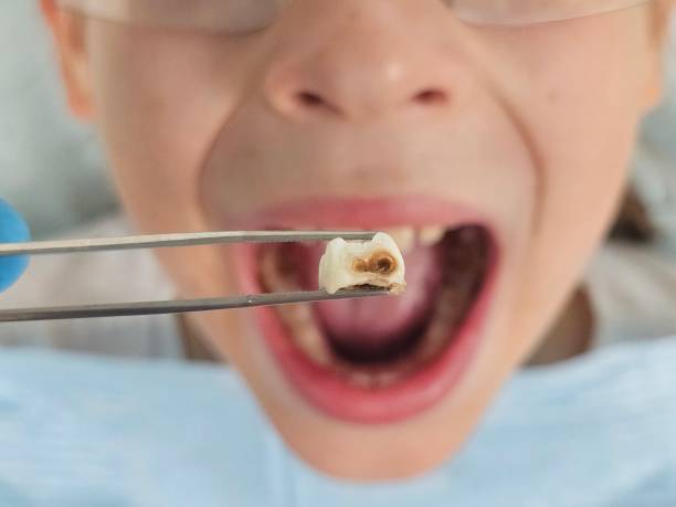 Best Urgent Tooth Repair  in Fruitdale, CA